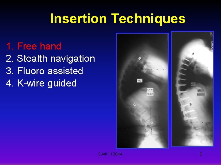 Insertion Techniques 1. Free hand 2. Stealth navigation 3. Fluoro assisted 4. K-wire guided