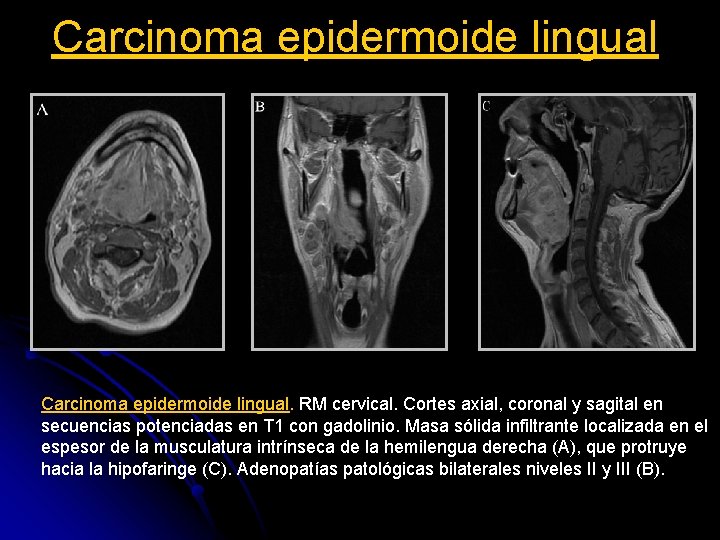 Carcinoma epidermoide lingual. RM cervical. Cortes axial, coronal y sagital en secuencias potenciadas en