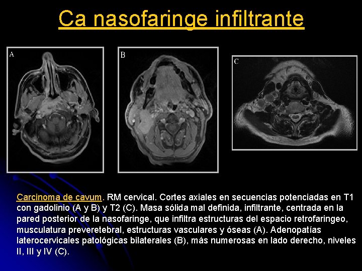 Ca nasofaringe infiltrante Carcinoma de cavum. RM cervical. Cortes axiales en secuencias potenciadas en