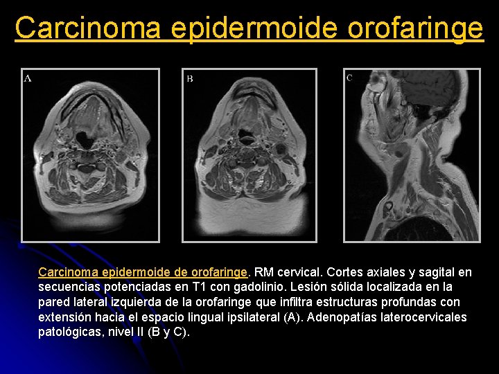 Carcinoma epidermoide orofaringe Carcinoma epidermoide de orofaringe. RM cervical. Cortes axiales y sagital en