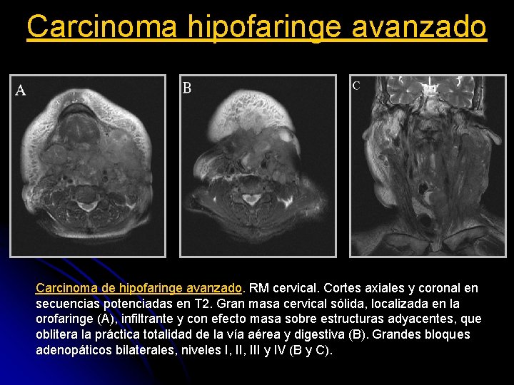 Carcinoma hipofaringe avanzado Carcinoma de hipofaringe avanzado. RM cervical. Cortes axiales y coronal en