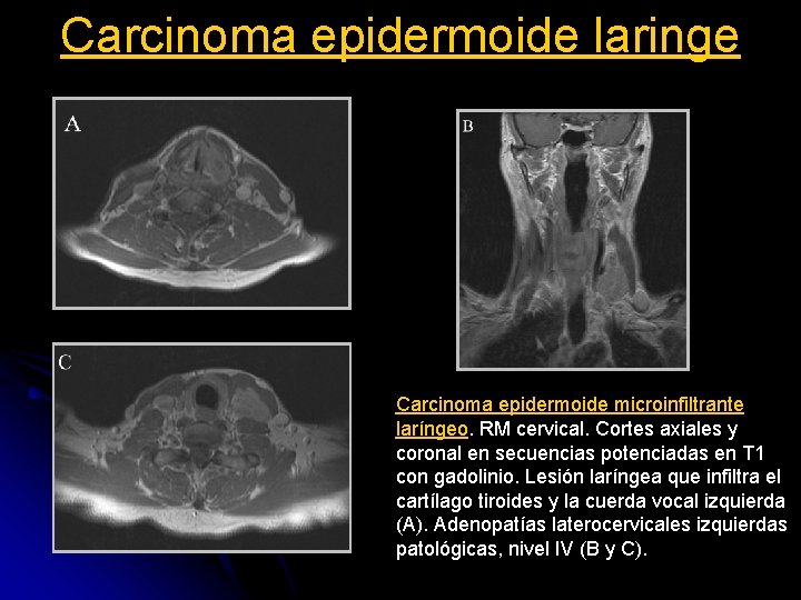Carcinoma epidermoide laringe Carcinoma epidermoide microinfiltrante laríngeo. RM cervical. Cortes axiales y coronal en