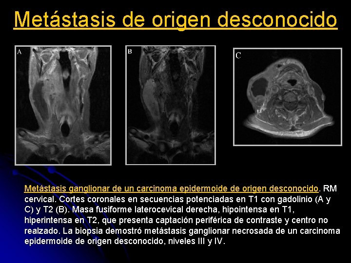 Metástasis de origen desconocido Metástasis ganglionar de un carcinoma epidermoide de origen desconocido. RM