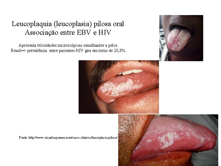 Leucoplaquia (leucoplasia) pilosa oral Associação entre EBV e HIV Apresenta vilosidades microscópicas semelhantes a