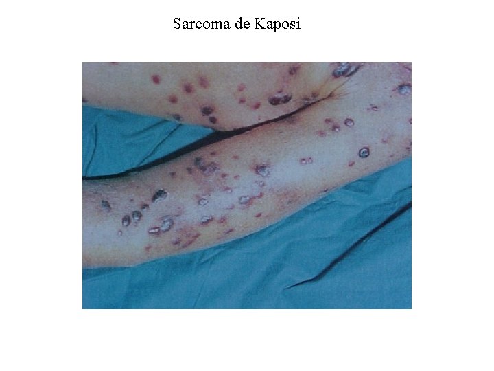 Sarcoma de Kaposi 