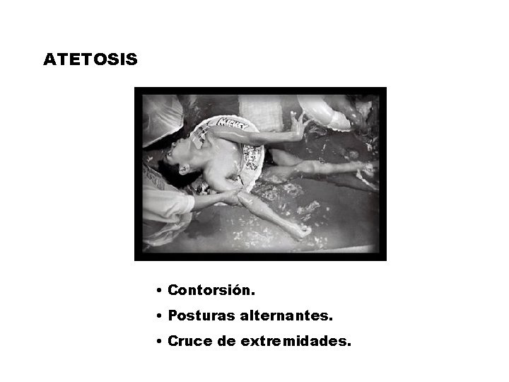 ATETOSIS • Contorsión. • Posturas alternantes. • Cruce de extremidades. 