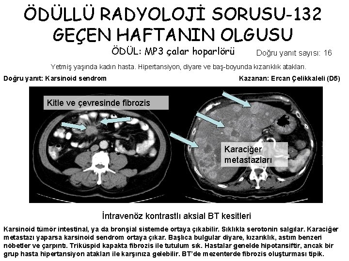 ÖDÜLLÜ RADYOLOJİ SORUSU-132 GEÇEN HAFTANIN OLGUSU ÖDÜL: MP 3 çalar hoparlörü Doğru yanıt sayısı: