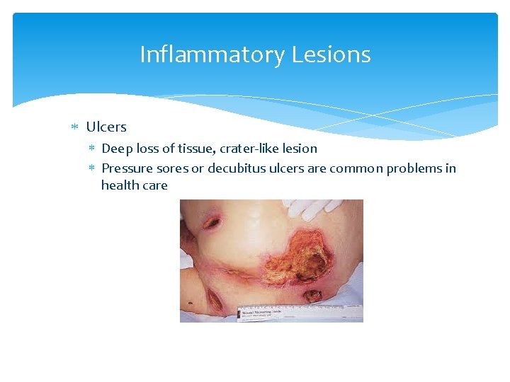 Inflammatory Lesions Ulcers Deep loss of tissue, crater-like lesion Pressure sores or decubitus ulcers