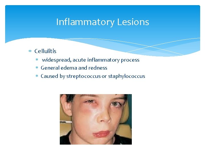 Inflammatory Lesions Cellulitis widespread, acute inflammatory process General edema and redness Caused by streptococcus