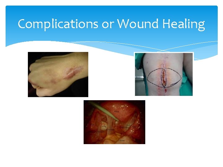 Complications or Wound Healing 