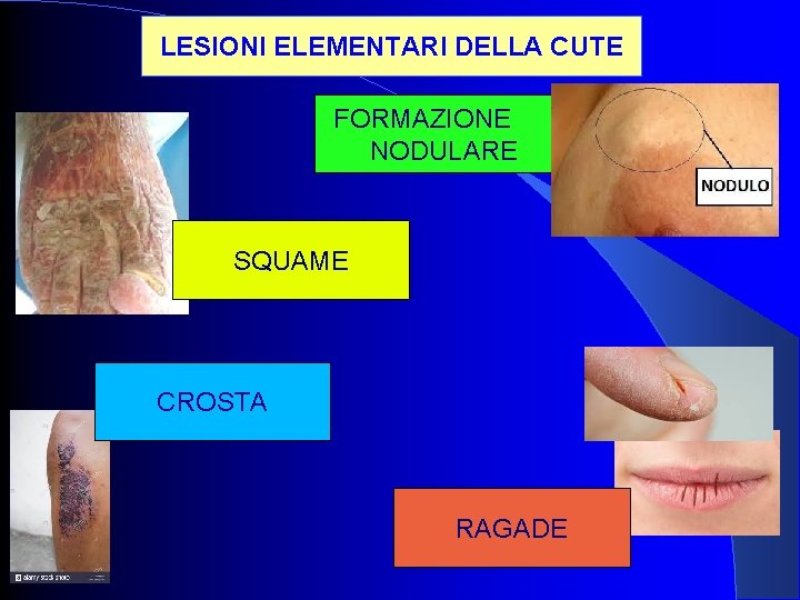 LESIONI ELEMENTARI DELLA CUTE FORMAZIONE NODULARE SQUAME CROSTA RAGADE LESIONI ELEMENTARI DELLA CUTE FORMAZIONE NODULARE SQUAME CROSTA RAGADE
