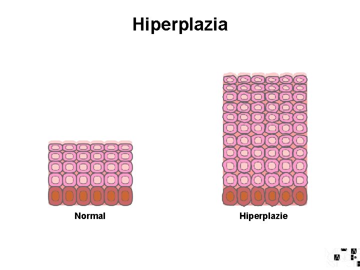 Hiperplazia Normal Hiperplazie 