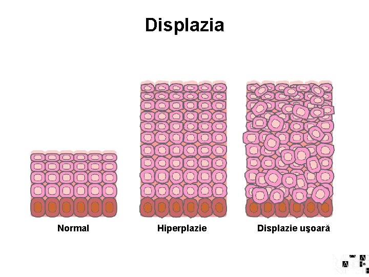 Displazia Normal Hiperplazie Displazie uşoară 