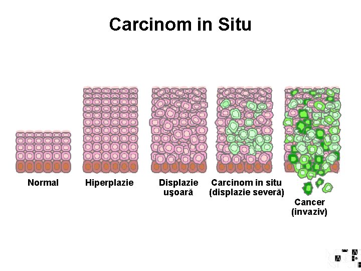 Carcinom in Situ Normal Hiperplazie Displazie uşoară Carcinom in situ (displazie severă) Cancer (invaziv)