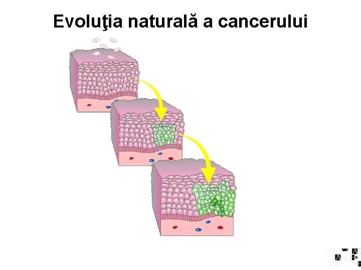 Evoluţia naturală a cancerului 