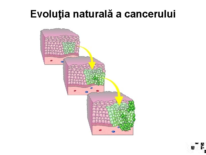Evoluţia naturală a cancerului 