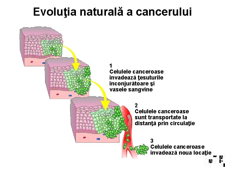 Evoluţia naturală a cancerului 1 Celulele canceroase invadează ţesuturile înconjurătoare şi vasele sangvine 2