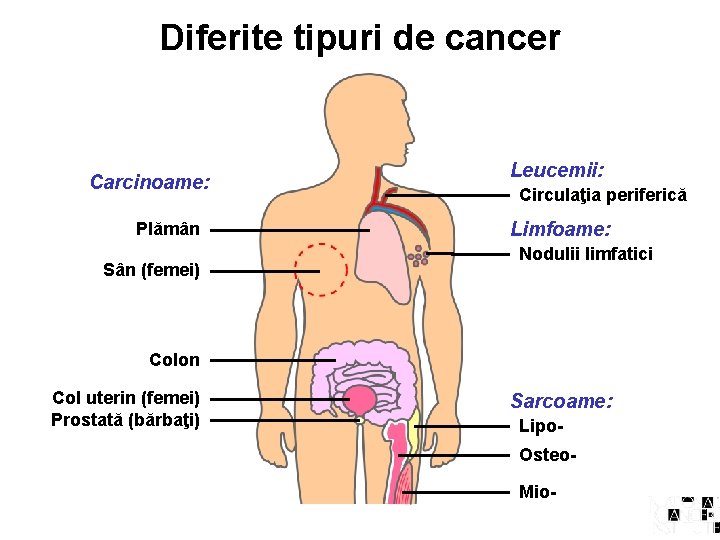 Diferite tipuri de cancer Carcinoame: Plămân Sân (femei) Leucemii: Circulaţia periferică Limfoame: Nodulii limfatici