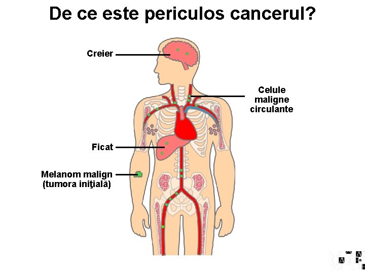 De ce este periculos cancerul? Creier Celule maligne circulante Ficat Melanom malign (tumora iniţială)