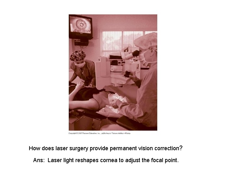 How does laser surgery provide permanent vision correction? Ans: Laser light reshapes cornea to How does laser surgery provide permanent vision correction? Ans: Laser light reshapes cornea to