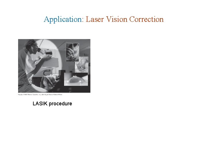 Application: Laser Vision Correction LASIK procedure Application: Laser Vision Correction LASIK procedure