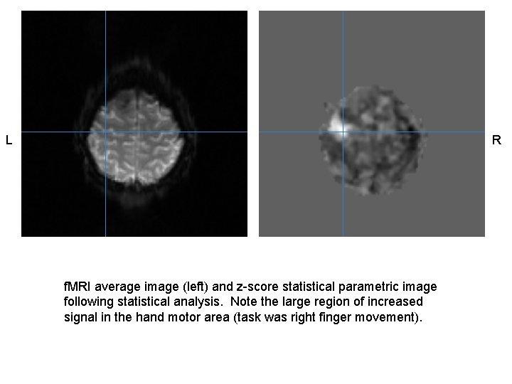 L R f. MRI average image (left) and z-score statistical parametric image following statistical