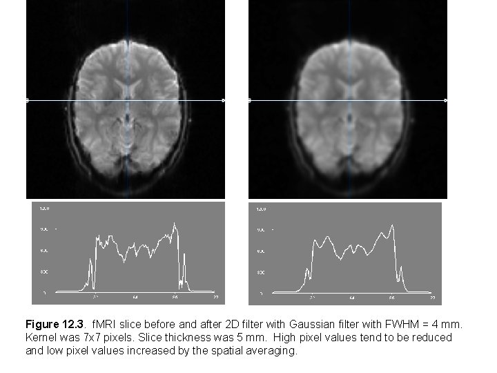 Figure 12. 3. f. MRI slice before and after 2 D filter with Gaussian