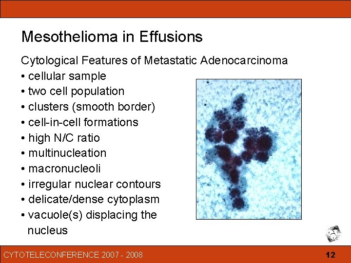 mesothelioma ovary pathology outlines