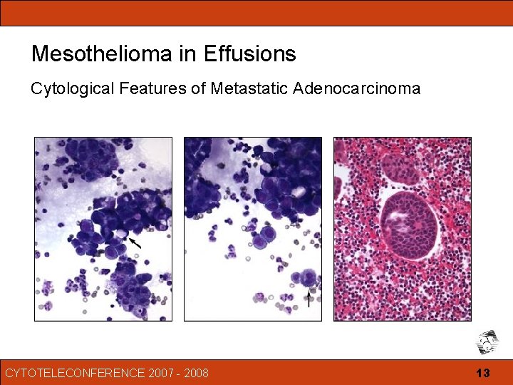 can ultrasound detect mesothelioma