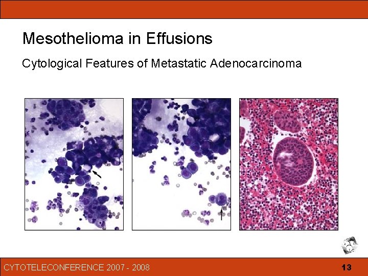 mesothelioma ipilimumab and nivolumab