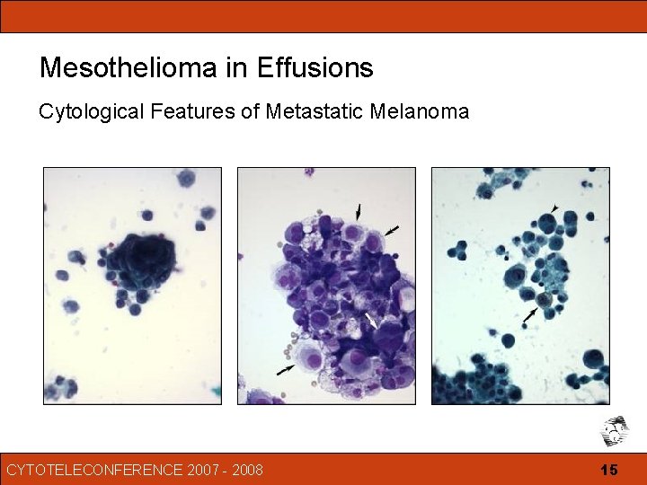 gemcitabine in malignant pleural mesothelioma