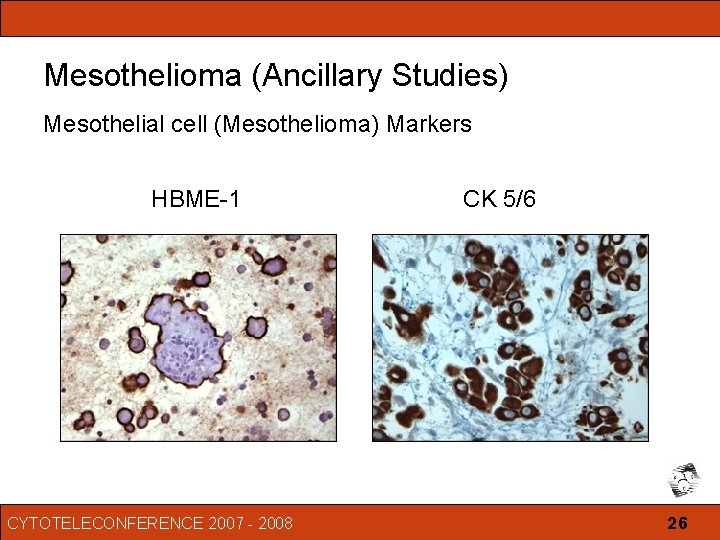 peritoneal mesothelioma ribbon color