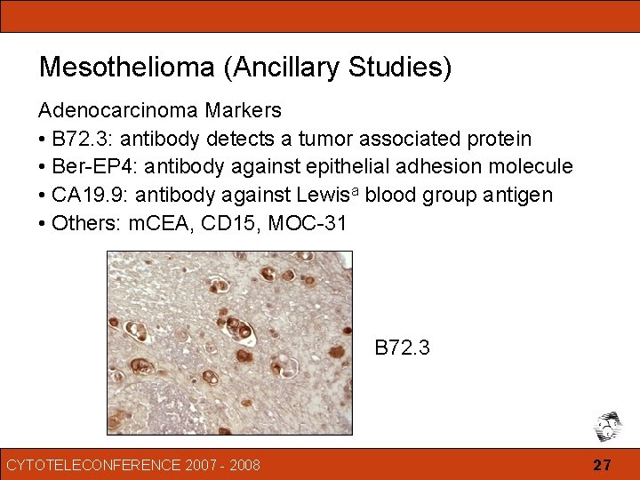 mesothelioma survival rate without treatment