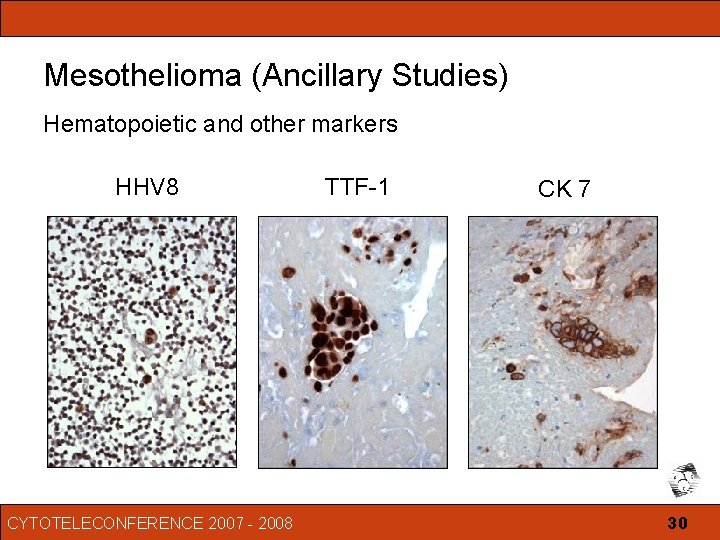 progressive malignant pleural mesothelioma