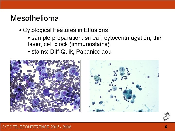 pax8 staining in mesothelioma
