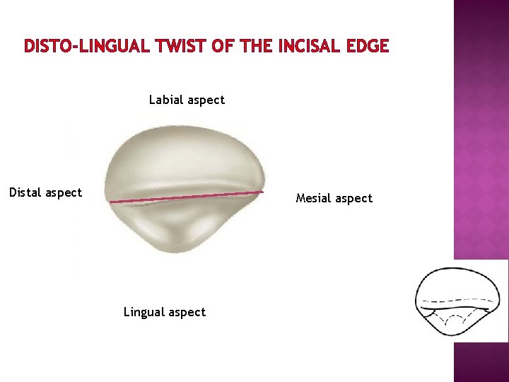 DISTO-LINGUAL TWIST OF THE INCISAL EDGE Labial aspect Distal aspect Mesial aspect Lingual aspect