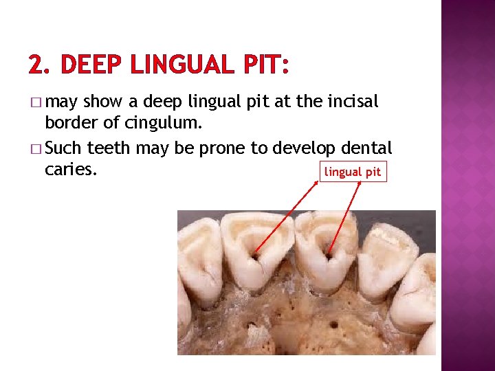2. DEEP LINGUAL PIT: � may show a deep lingual pit at the incisal