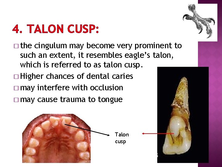 4. TALON CUSP: � the cingulum may become very prominent to such an extent,