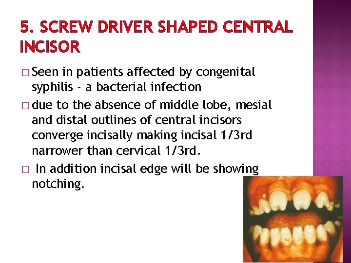 5. SCREW DRIVER SHAPED CENTRAL INCISOR � Seen in patients affected by congenital syphilis