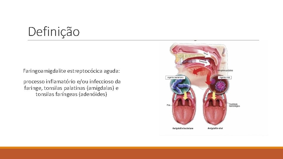 Definição Faringoamigdalite estreptocócica aguda: processo inflamatório e/ou infeccioso da faringe, tonsilas palatinas (amígdalas) e