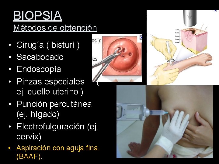 BIOPSIA Métodos de obtención • • Cirugía ( bisturí ) Sacabocado Endoscopía Pinzas especiales