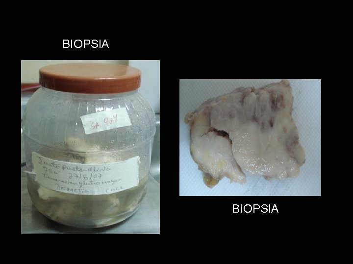 BIOPSIA 