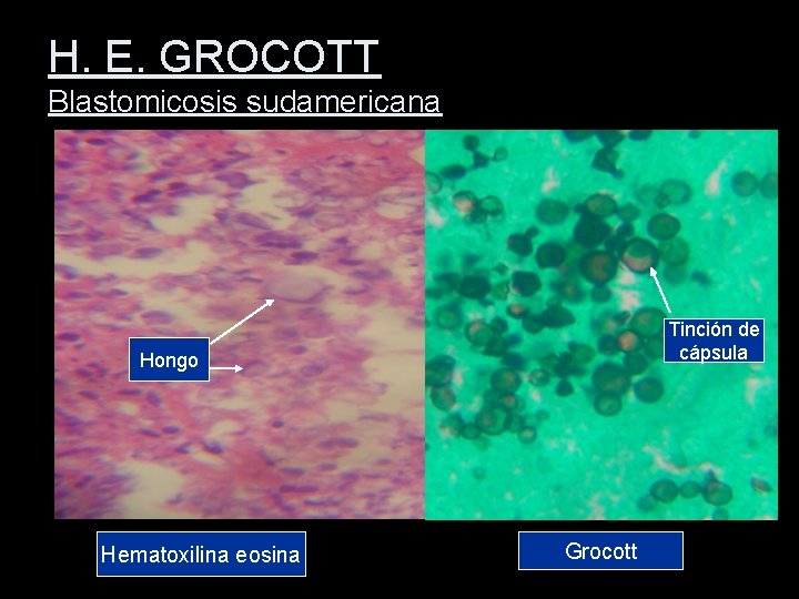 H. E. GROCOTT Blastomicosis sudamericana Tinción de cápsula Hongo Hematoxilina eosina Grocott 