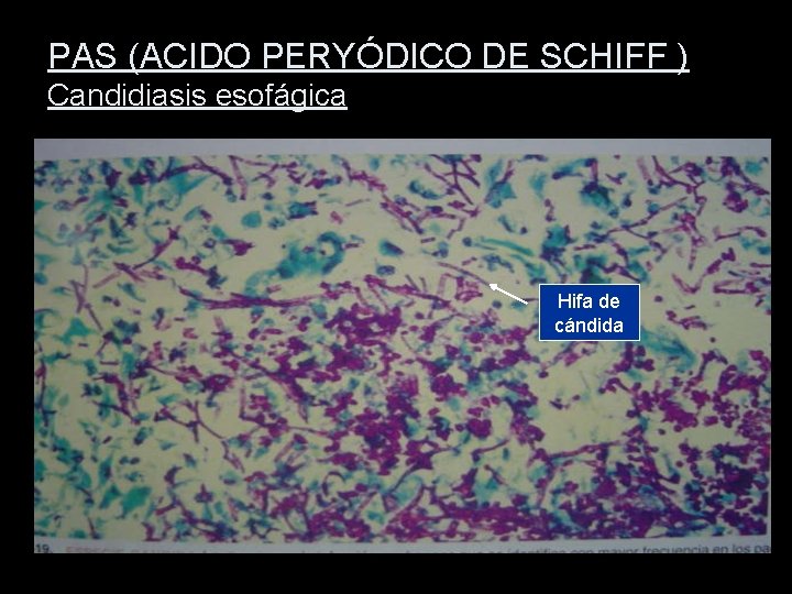 PAS (ACIDO PERYÓDICO DE SCHIFF ) Candidiasis esofágica Hifa de cándida 