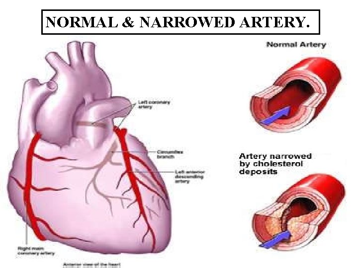 NORMAL & NARROWED ARTERY. 5 