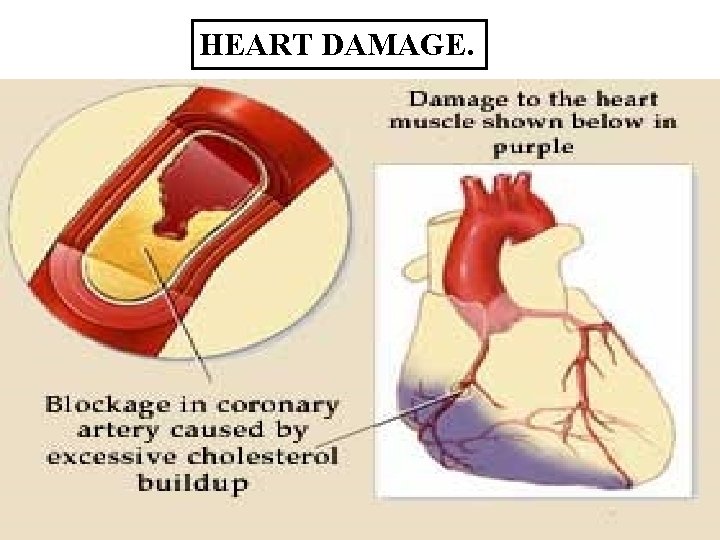 HEART DAMAGE. 6 