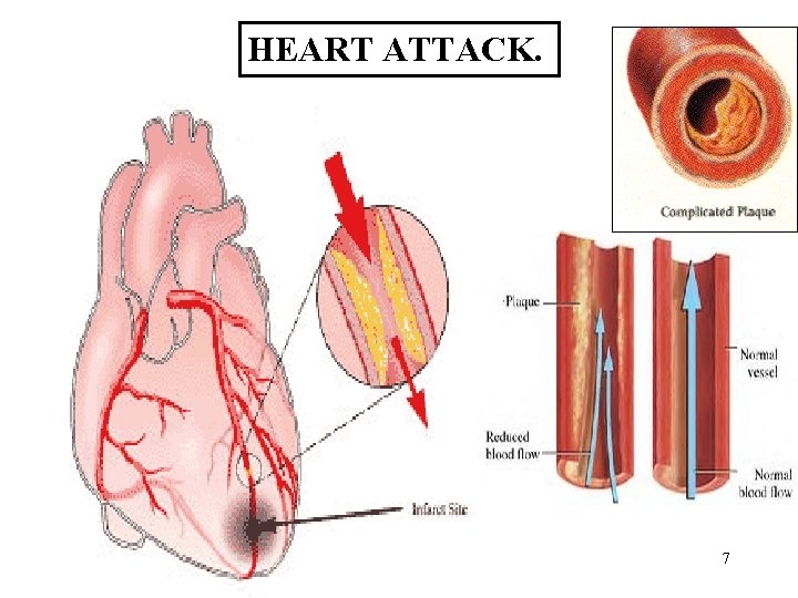 HEART ATTACK. 7 