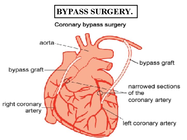 BYPASS SURGERY. 8 