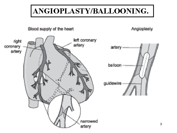 ANGIOPLASTY/BALLOONING. 9 