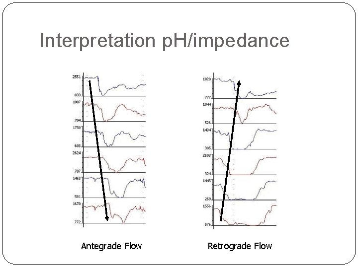 Interpretation p. H/impedance Antegrade Flow Retrograde Flow 